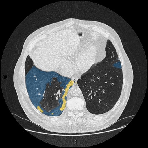 dataset-2-case-01 - MedSeg COVID-19 CT case preview