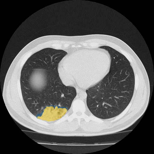 dataset-2-case-02 - MedSeg COVID-19 CT case preview