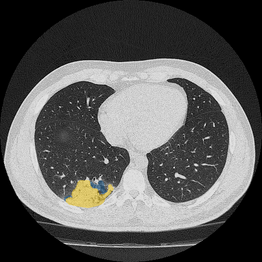 dataset-2-case-03 - MedSeg COVID-19 CT case preview