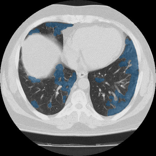 dataset-2-case-04 - MedSeg COVID-19 CT case preview