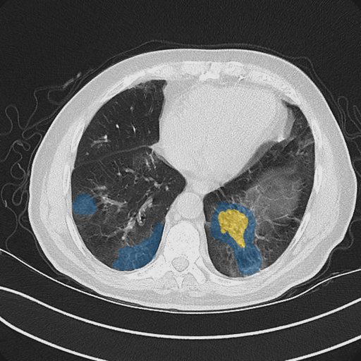 dataset-2-case-05 - MedSeg COVID-19 CT case preview