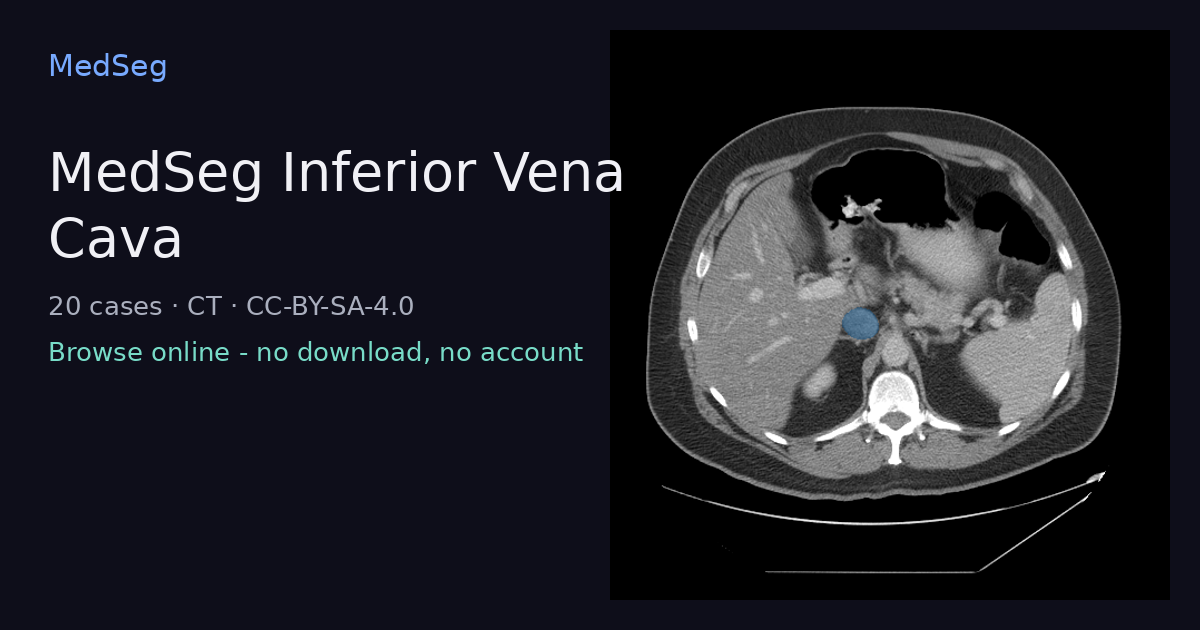 MedSeg Inferior Vena Cava - example case rendered in the MedSeg editor