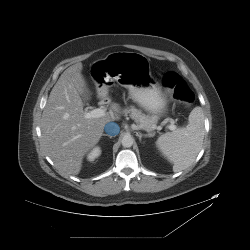 MedSeg Inferior Vena Cava preview