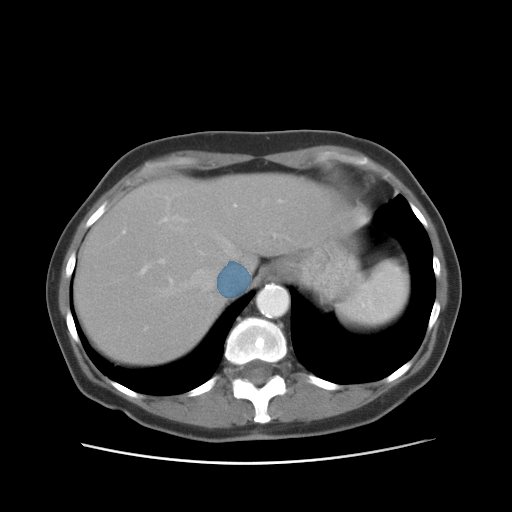 case-02 - MedSeg Inferior Vena Cava case preview