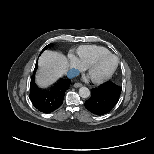 case-03 - MedSeg Inferior Vena Cava case preview