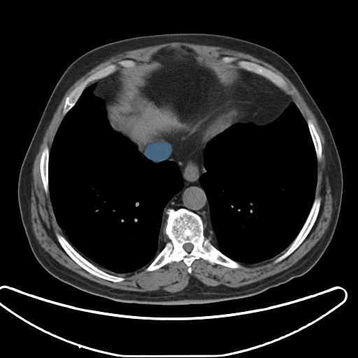case-04 - MedSeg Inferior Vena Cava case preview