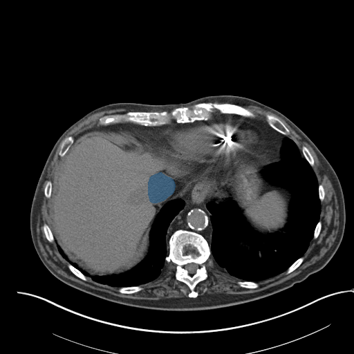 case-05 - MedSeg Inferior Vena Cava case preview