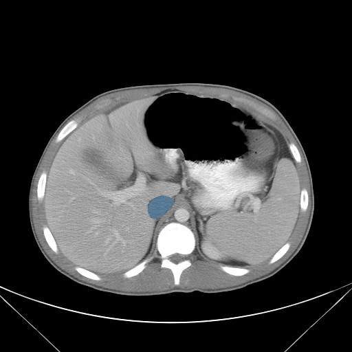 case-06 - MedSeg Inferior Vena Cava case preview
