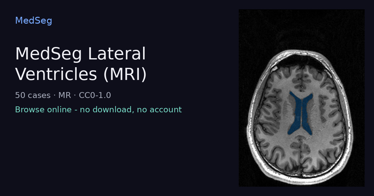 MedSeg Lateral Ventricles (MRI) - example case rendered in the MedSeg editor