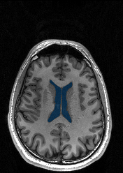 MedSeg Lateral Ventricles (MRI) preview