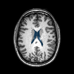 case-02 - MedSeg Lateral Ventricles (MRI) case preview
