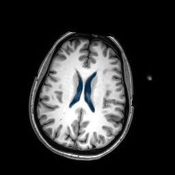 case-03 - MedSeg Lateral Ventricles (MRI) case preview