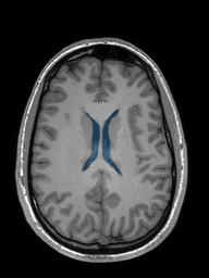 case-04 - MedSeg Lateral Ventricles (MRI) case preview