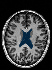 case-05 - MedSeg Lateral Ventricles (MRI) case preview