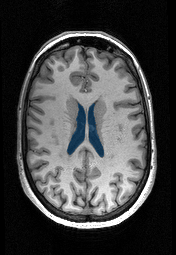 case-06 - MedSeg Lateral Ventricles (MRI) case preview