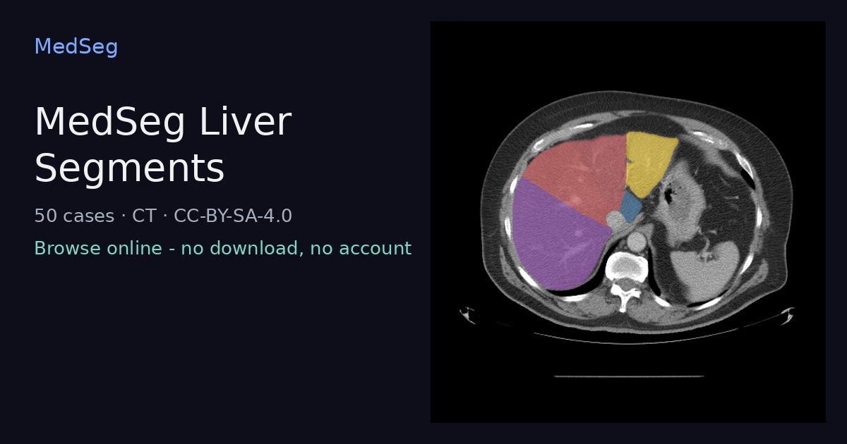 MedSeg Liver Segments - example case rendered in the MedSeg editor