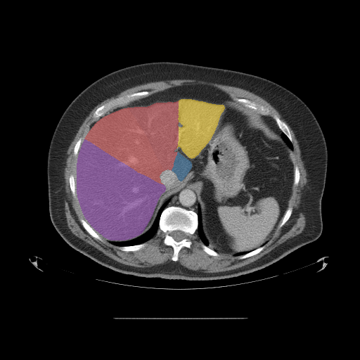 MedSeg Liver Segments preview