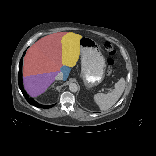 case-02 - MedSeg Liver Segments case preview