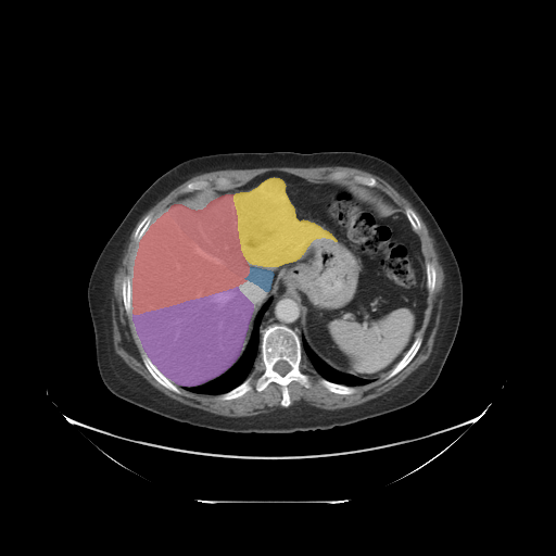 case-03 - MedSeg Liver Segments case preview