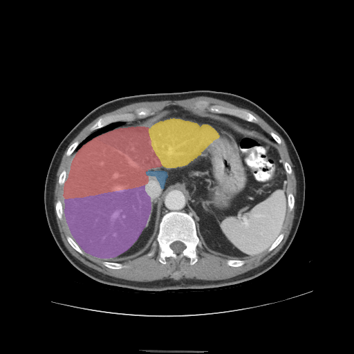 case-04 - MedSeg Liver Segments case preview