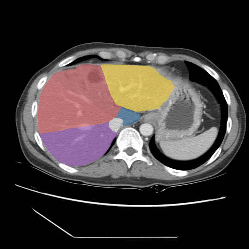 case-05 - MedSeg Liver Segments case preview
