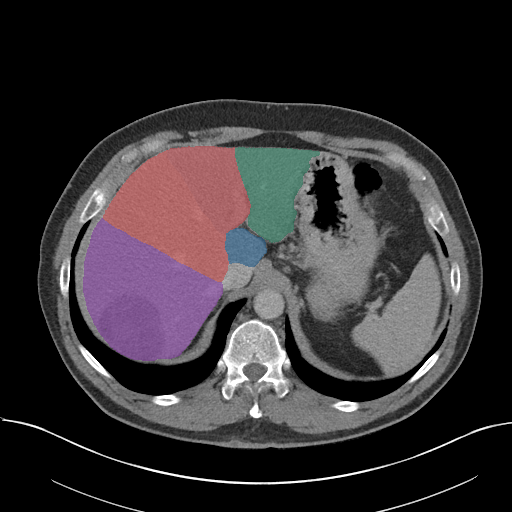 case-06 - MedSeg Liver Segments case preview