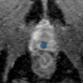 train-020-adc - Prostate158 - 3T prostate MRI case preview
