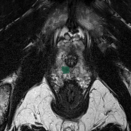train-020-t2 - Prostate158 - 3T prostate MRI case preview