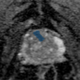 train-021-adc - Prostate158 - 3T prostate MRI case preview