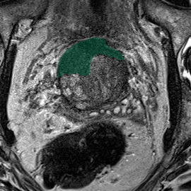 train-025-t2 - Prostate158 - 3T prostate MRI case preview