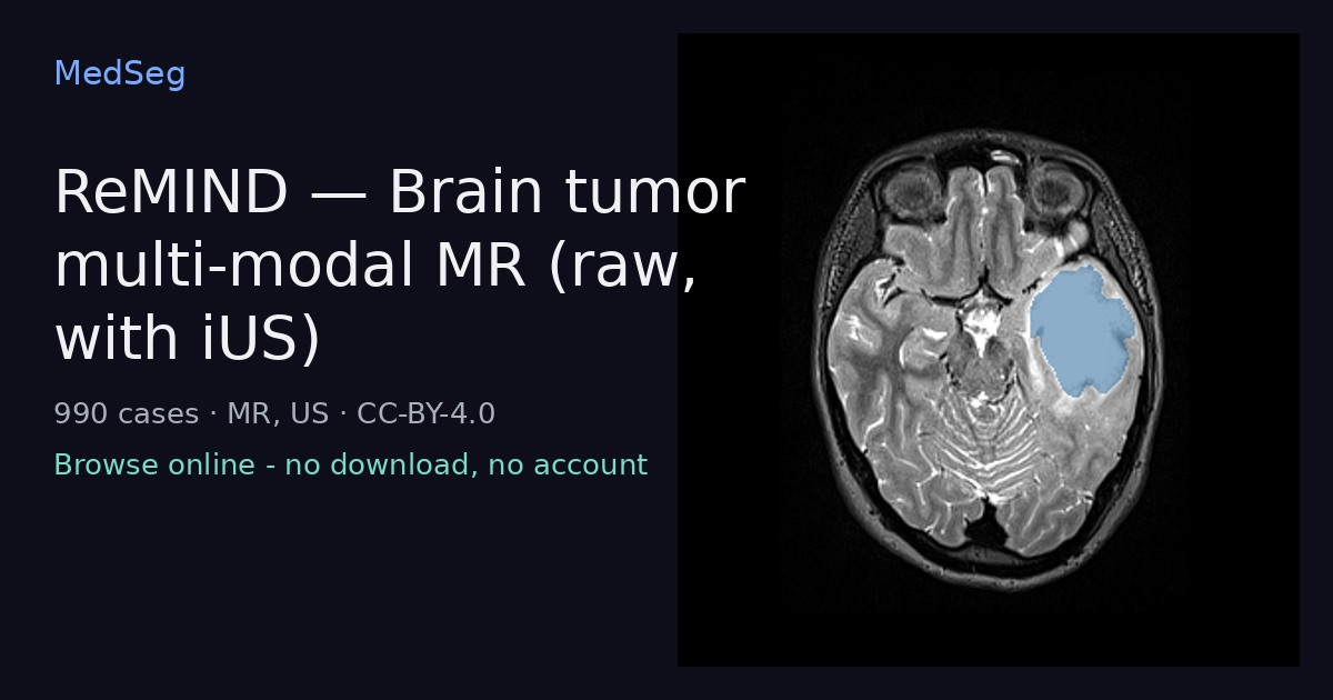 ReMIND - Brain tumor multi-modal MR (raw, with iUS) - example case rendered in the MedSeg editor