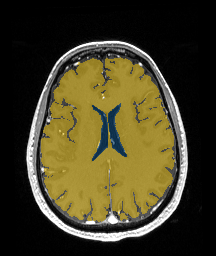ReMIND-001__3d-ax-t1-postcontrast - ReMIND - Brain tumor multi-modal MR (raw, with iUS) case preview