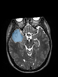 ReMIND-001__3d-sag-t2-space - ReMIND - Brain tumor multi-modal MR (raw, with iUS) case preview