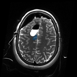 ReMIND-002__2d-ax-t2-blade - ReMIND - Brain tumor multi-modal MR (raw, with iUS) case preview