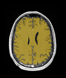 ReMIND-002__3d-ax-t1-postcontrast - ReMIND - Brain tumor multi-modal MR (raw, with iUS) case preview
