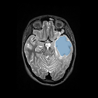 ReMIND - Brain tumor multi-modal MR (raw, with iUS) preview