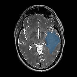 ReMIND-114__3d-ax-t2-space - ReMIND - Brain tumor multi-modal MR (raw, with iUS) case preview