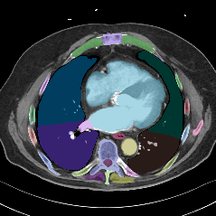 TotalSegmentator v2 CT preview from the MedSeg public dataset catalog.