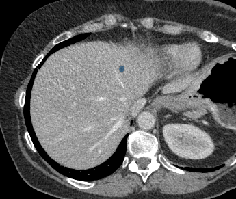 TotalSegmentator - Liver Lesions (mixed MR + CT) preview