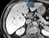 0BJc4QeljgijtV18 - TotalSegmentator - Liver Lesions (mixed MR + CT) case preview