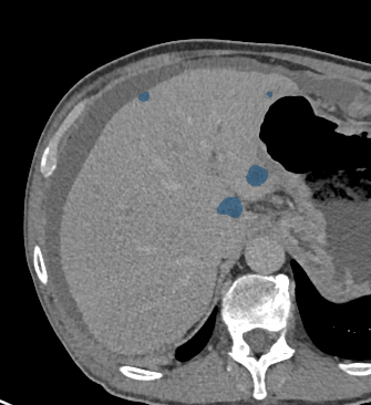 0LdaHSWA3EHk8VVe - TotalSegmentator - Liver Lesions (mixed MR + CT) case preview