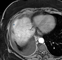0T5z5N7BsISCX6Dn - TotalSegmentator - Liver Lesions (mixed MR + CT) case preview
