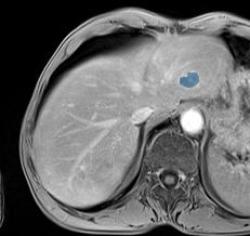 DKo8yzLWB3zCWZig - TotalSegmentator - Liver Lesions (mixed MR + CT) case preview