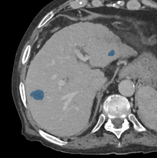 vuPw782Wez5chyd4 - TotalSegmentator - Liver Lesions (mixed MR + CT) case preview