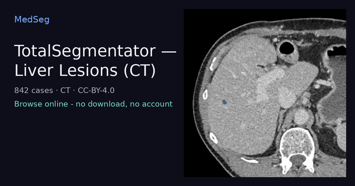TotalSegmentator - Liver Lesions (CT) - example case rendered in the MedSeg editor