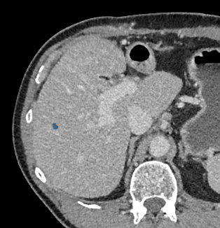 TotalSegmentator - Liver Lesions (CT) preview