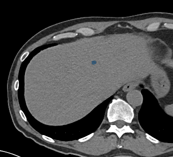 0AbJHdnCKYU14XnY - TotalSegmentator - Liver Lesions (CT) case preview