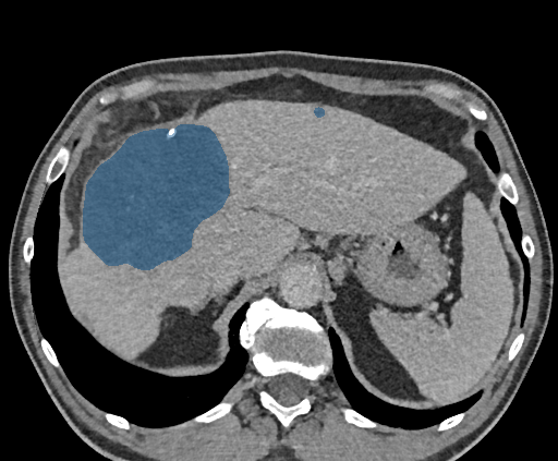 0LHth9cfqxoisxhI - TotalSegmentator - Liver Lesions (CT) case preview