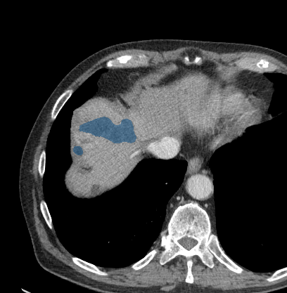 0R65xRVtCrSfrJQC - TotalSegmentator - Liver Lesions (CT) case preview