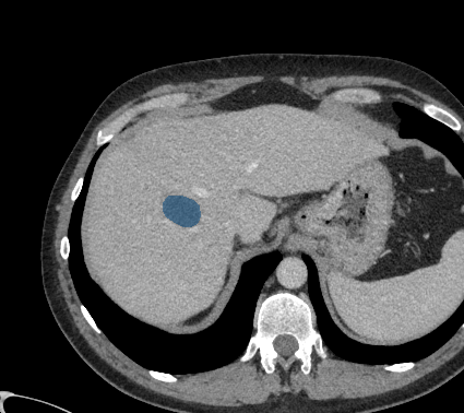 86FNMi2QiFmquhyj - TotalSegmentator - Liver Lesions (CT) case preview